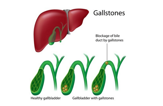 Cholecystectomy (Gallbladder Removal) Surgery In India : Cost ...